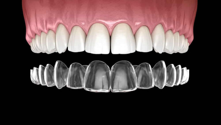 vInvisalign-Newport-Beach-Dentist-The-Gentle-Dentist-of-Newport-Beach-Ca-768x435